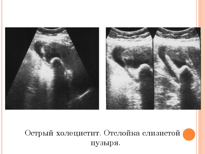 Острый холецистит. Отслойка слизистой пузыря.